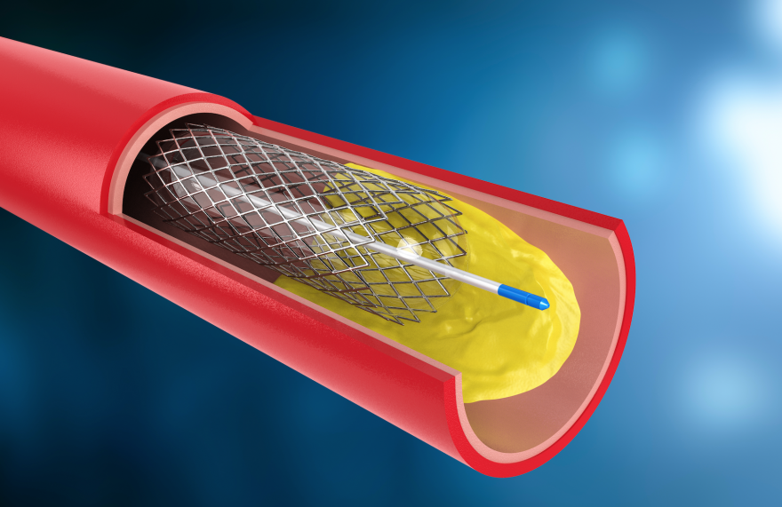 Qual a diferença entre cateterismo e angioplastia?